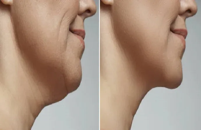 Effective Chin Sculpting Treatment in Dubai | Glamorous Clinic in Dubai