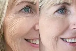 Skin Revitalization Made Easy with Skin Booster Injections in Dubai & Abu Dhabi – Glamorous Clinic in Dubai