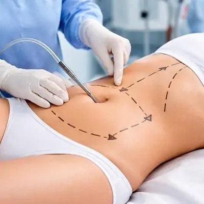 Gentle Vibro Liposuction Procedures | Glamorous Clinic in Dubai