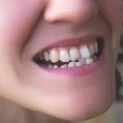 Get Straighter Teeth with Expert Treatment in Dubai | Glamorous Clinic Dubai