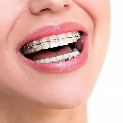 Teeth Braces in Dubai & Abu Dhabi for a Confident Smile | Glamorous Clinic Dubai