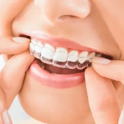 Invisalign Treatment Dubai & Abu Dhabi for Advanced Clear Aligners | Glamorous Clinic Dubai