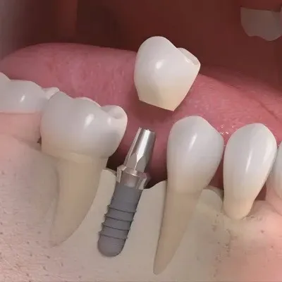 Dental Implants Dubai & Abu Dhabi for a Confident Smile | Glamorous Clinic Dubai