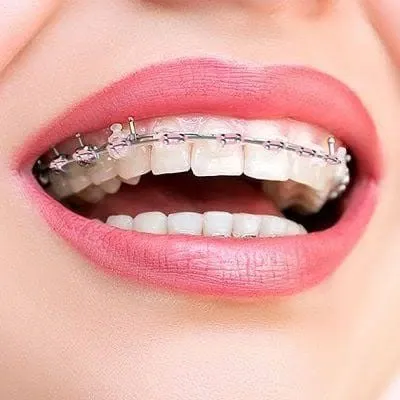 Dentofacial Orthopedics in Dubai for Growing Patients | Glamorous Clinic Dubai