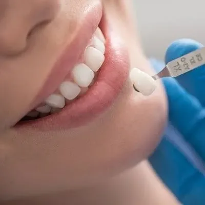 Ceramic Crown Dubai & Abu Dhabi for Long-Lasting Smile Care