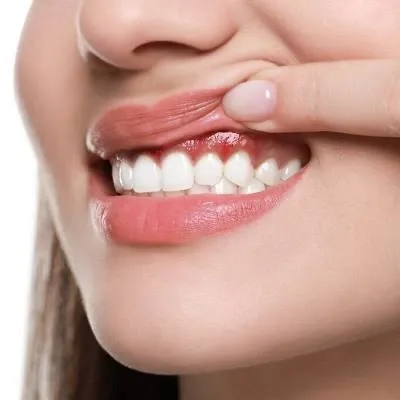 Gum Contouring Dubai & Abu Dhabi for a Beautiful Smile | Glamorous Clinic Dubai